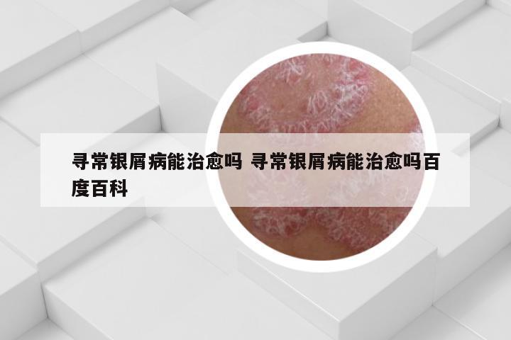 寻常银屑病能治愈吗 寻常银屑病能治愈吗百度百科