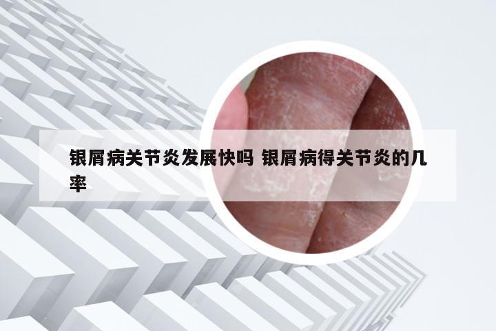 银屑病关节炎发展快吗 银屑病得关节炎的几率