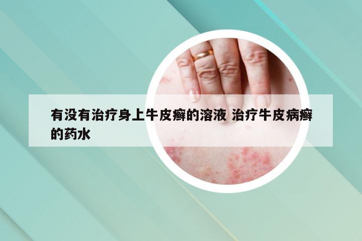 有没有治疗身上牛皮癣的溶液 治疗牛皮病癣的药水