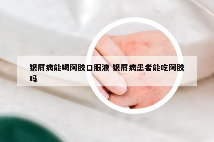 银屑病能喝阿胶口服液 银屑病患者能吃阿胶吗