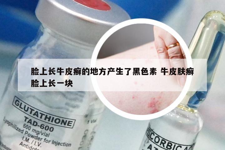 脸上长牛皮癣的地方产生了黑色素 牛皮肤癣脸上长一块