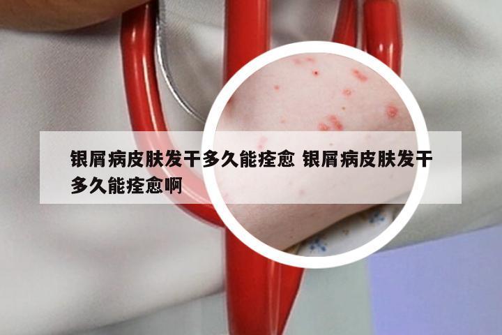 银屑病皮肤发干多久能痊愈 银屑病皮肤发干多久能痊愈啊