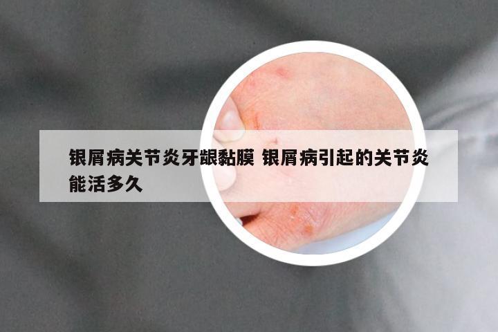 银屑病关节炎牙龈黏膜 银屑病引起的关节炎能活多久