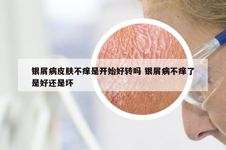 银屑病皮肤不痒是开始好转吗 银屑病不痒了是好还是坏