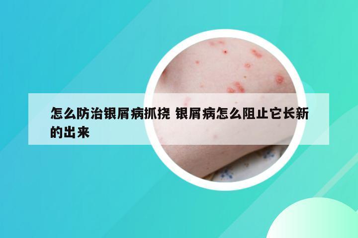 怎么防治银屑病抓挠 银屑病怎么阻止它长新的出来