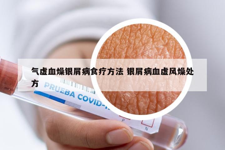 气虚血燥银屑病食疗方法 银屑病血虚风燥处方