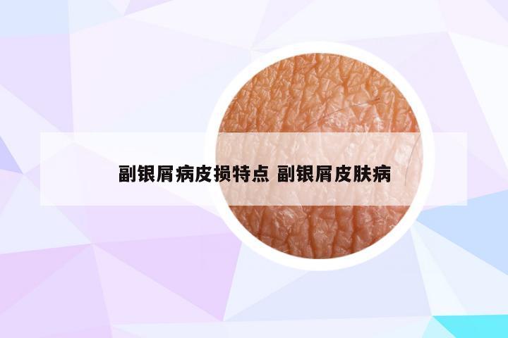 副银屑病皮损特点 副银屑皮肤病
