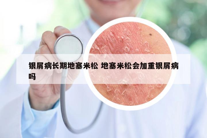 银屑病长期地塞米松 地塞米松会加重银屑病吗