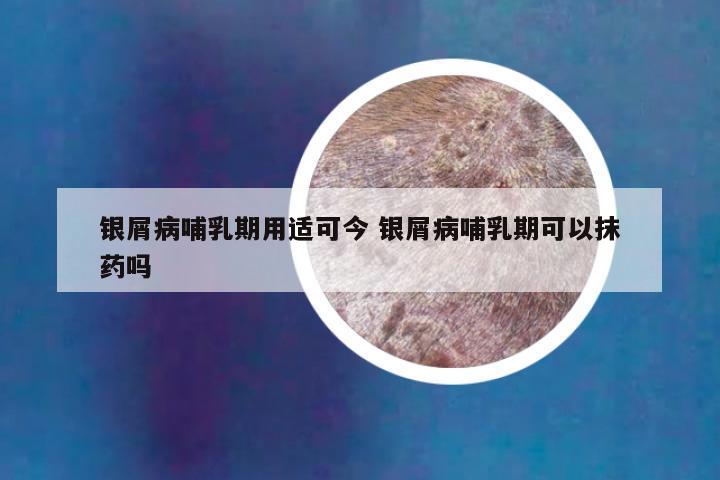 银屑病哺乳期用适可今 银屑病哺乳期可以抹药吗