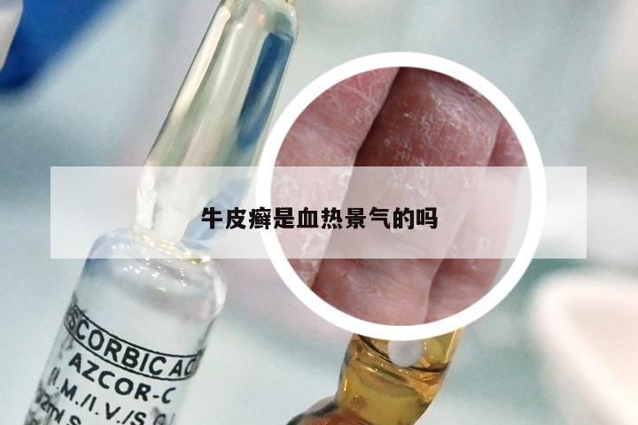 牛皮癣是血热景气的吗