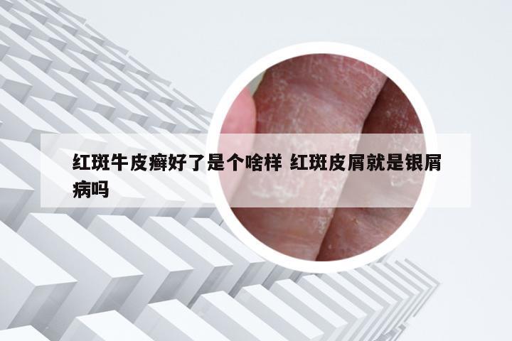 红斑牛皮癣好了是个啥样 红斑皮屑就是银屑病吗