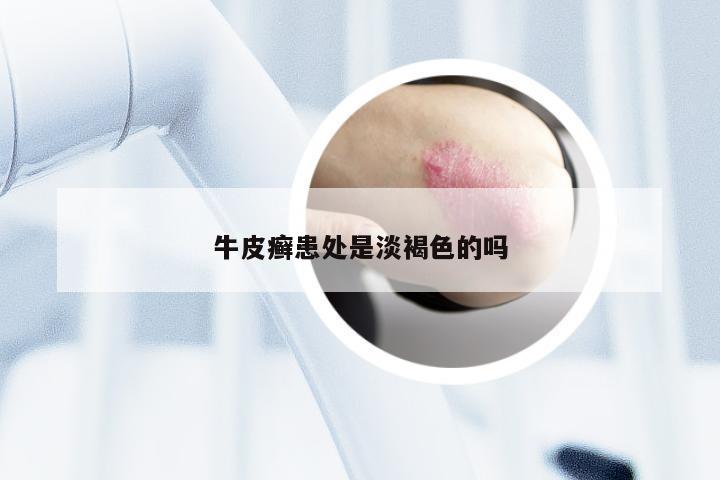牛皮癣患处是淡褐色的吗