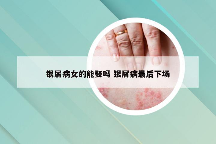 银屑病女的能娶吗 银屑病最后下场