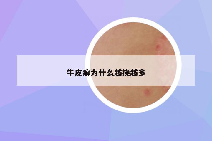 牛皮癣为什么越挠越多