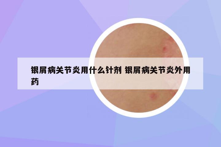 银屑病关节炎用什么针剂 银屑病关节炎外用药