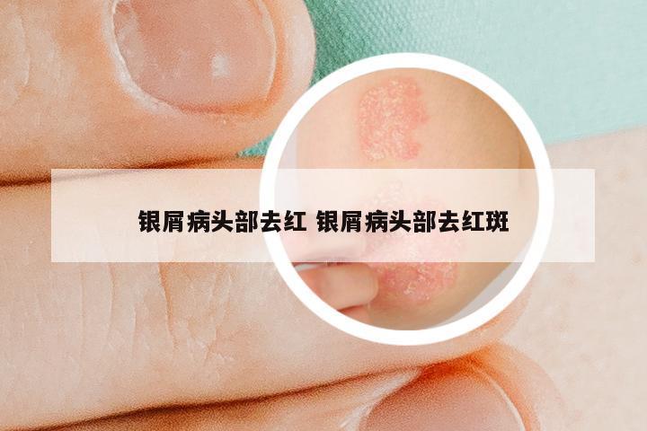 银屑病头部去红 银屑病头部去红斑
