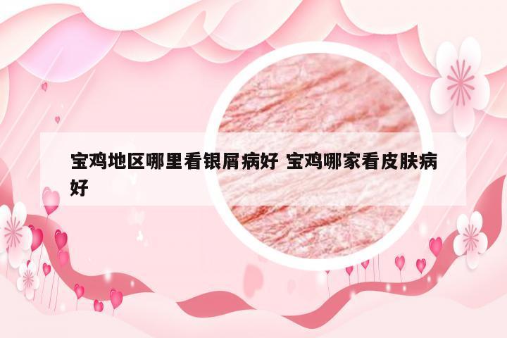宝鸡地区哪里看银屑病好 宝鸡哪家看皮肤病好