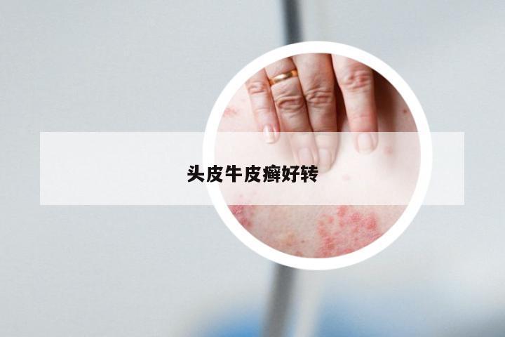 头皮牛皮癣好转