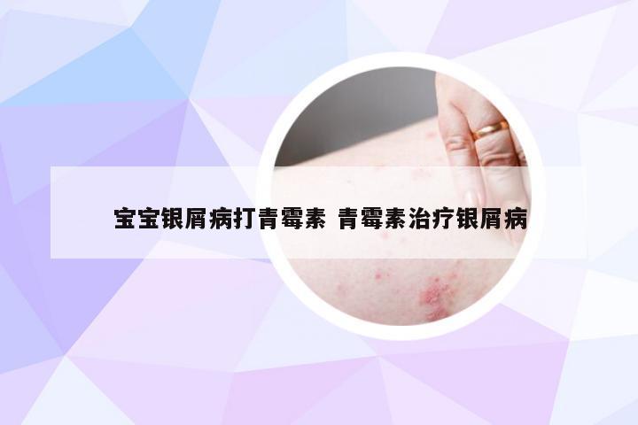宝宝银屑病打青霉素 青霉素治疗银屑病