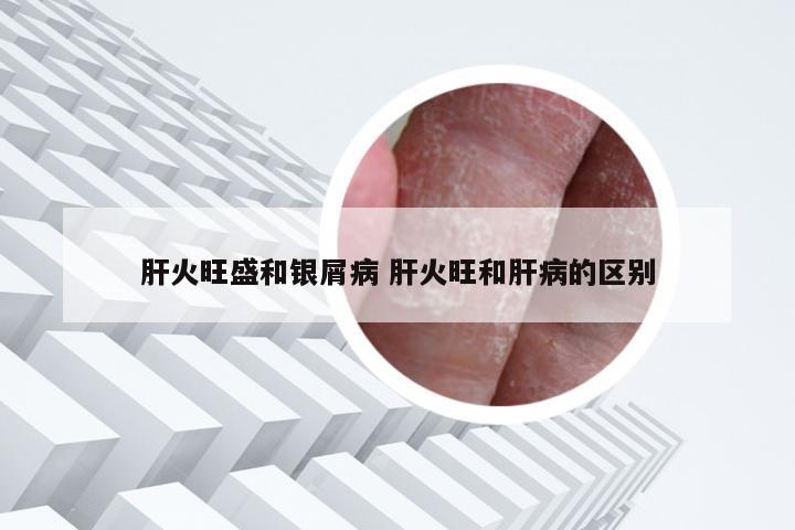 肝火旺盛和银屑病 肝火旺和肝病的区别