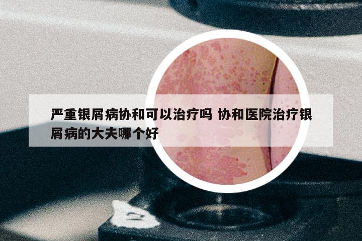 严重银屑病协和可以治疗吗 协和医院治疗银屑病的大夫哪个好
