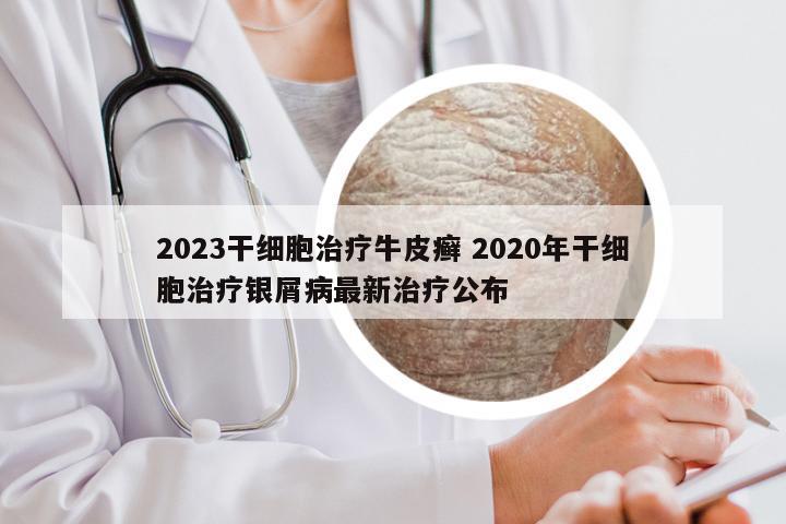 2023干细胞治疗牛皮癣 2020年干细胞治疗银屑病最新治疗公布