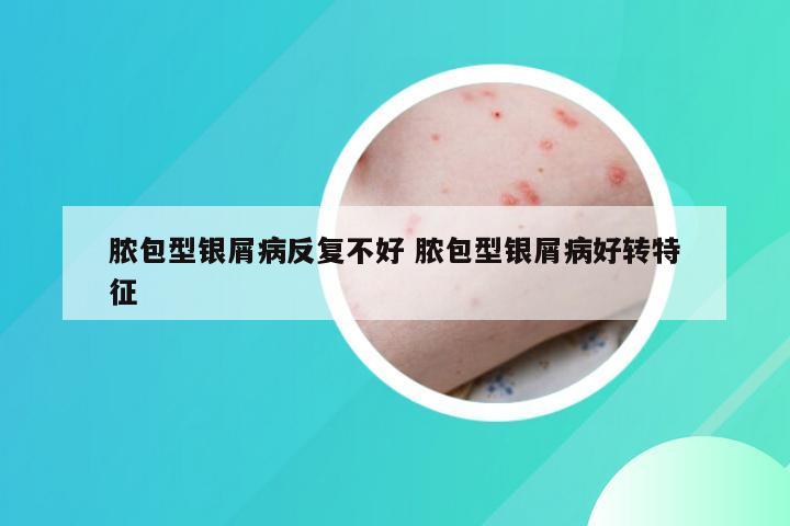 脓包型银屑病反复不好 脓包型银屑病好转特征