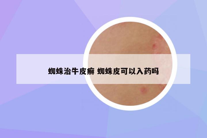 蜘蛛治牛皮癣 蜘蛛皮可以入药吗