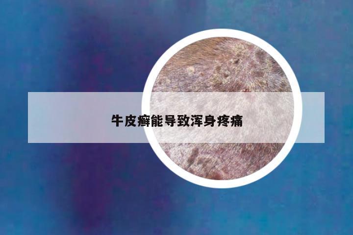 牛皮癣能导致浑身疼痛