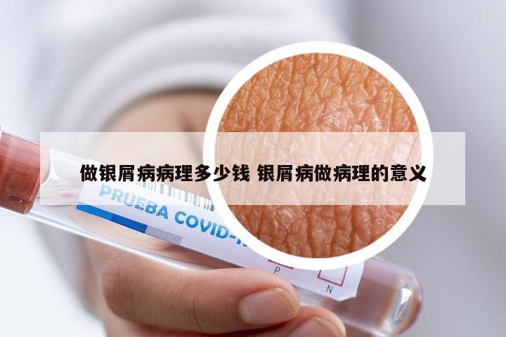 做银屑病病理多少钱 银屑病做病理的意义