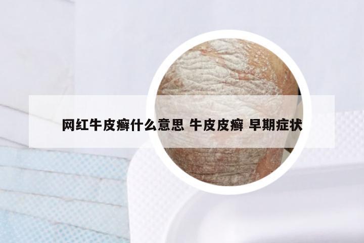 网红牛皮癣什么意思 牛皮皮癣 早期症状