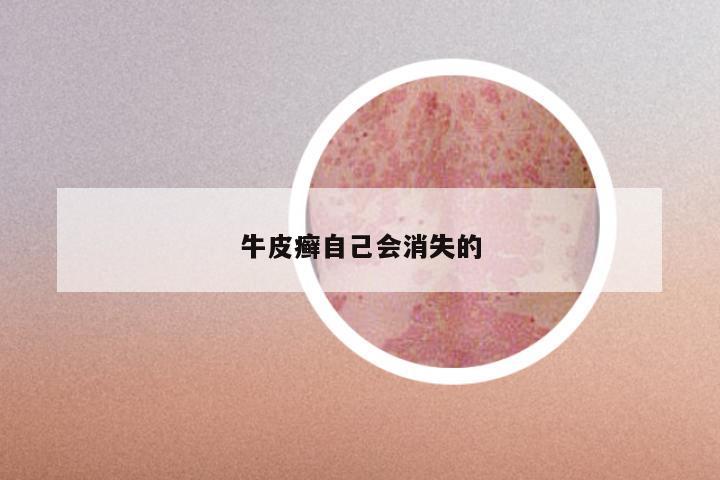 牛皮癣自己会消失的