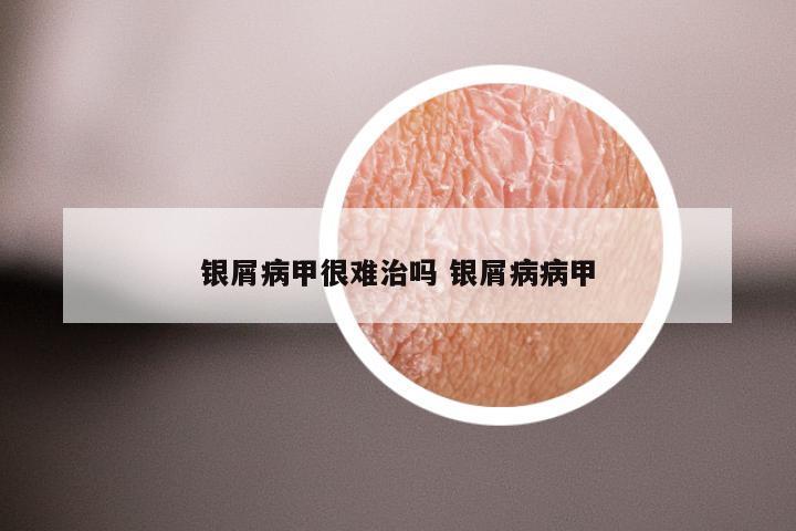 银屑病甲很难治吗 银屑病病甲