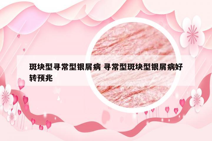 斑块型寻常型银屑病 寻常型斑块型银屑病好转预兆