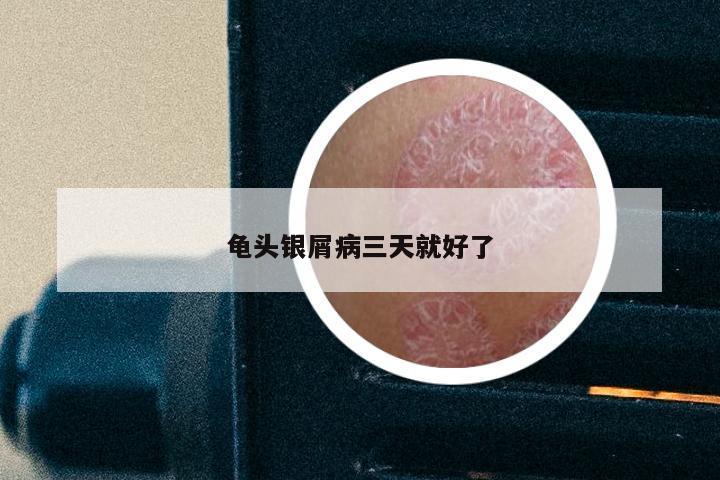 龟头银屑病三天就好了