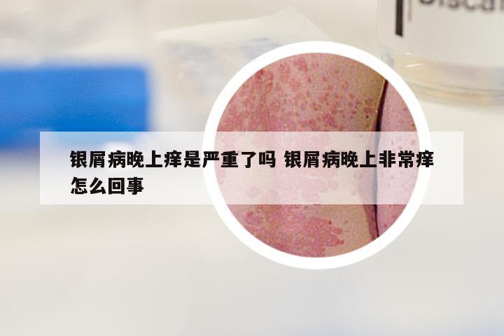 银屑病晚上痒是严重了吗 银屑病晚上非常痒怎么回事