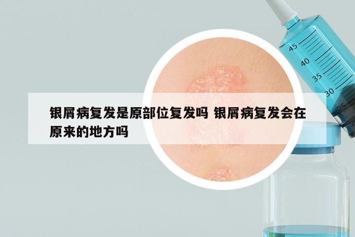 银屑病复发是原部位复发吗 银屑病复发会在原来的地方吗
