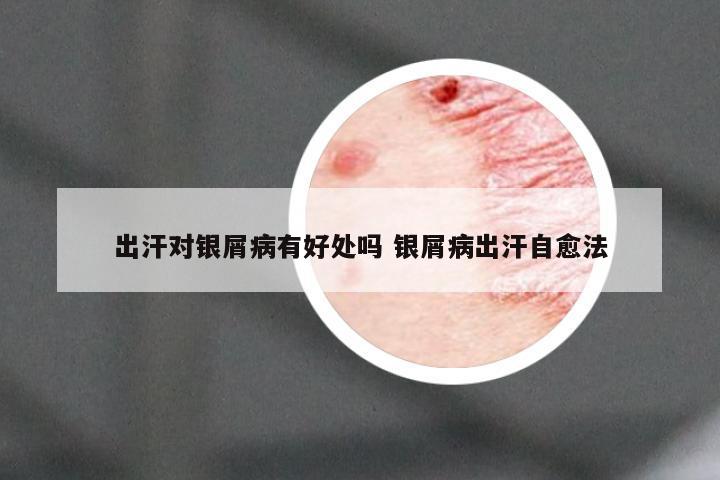 出汗对银屑病有好处吗 银屑病出汗自愈法