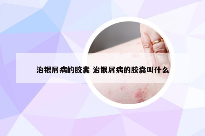 治银屑病的胶囊 治银屑病的胶囊叫什么