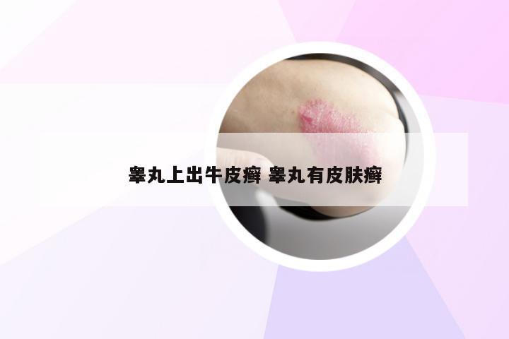 睾丸上出牛皮癣 睾丸有皮肤癣