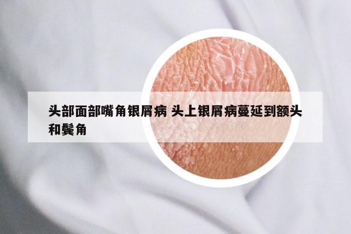 头部面部嘴角银屑病 头上银屑病蔓延到额头和鬓角