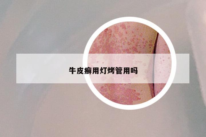 牛皮癣用灯烤管用吗