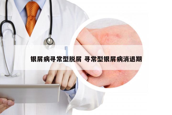 银屑病寻常型脱屑 寻常型银屑病消退期