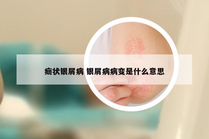 癍状银屑病 银屑病病变是什么意思