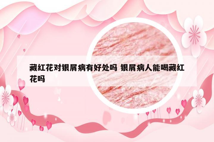 藏红花对银屑病有好处吗 银屑病人能喝藏红花吗