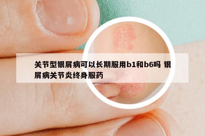 关节型银屑病可以长期服用b1和b6吗 银屑病关节炎终身服药