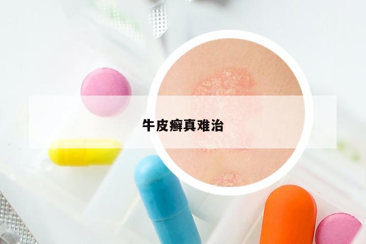 牛皮癣真难治