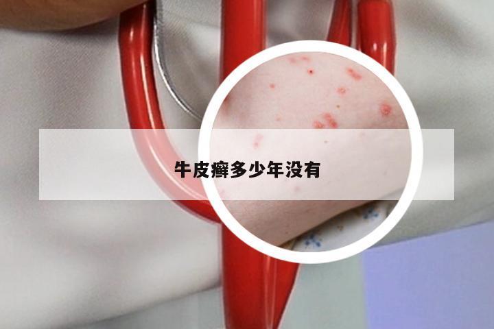 牛皮癣多少年没有