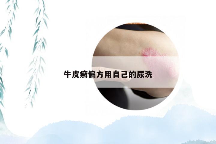 牛皮癣偏方用自己的尿洗