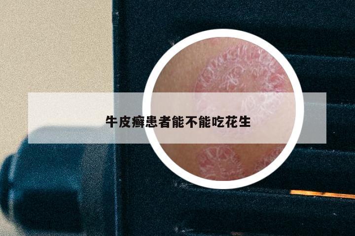 牛皮癣患者能不能吃花生